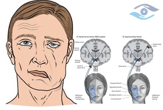 Paralisis Facial
